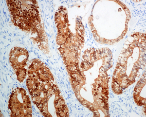 IHC of paraffin-embedded human pancreatic adenocarcinoma tissue using anti-S100P antibody. 