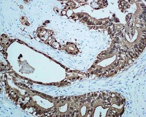 IHC of paraffin-embedded human pancreatic adenocarcinoma tissue using anti-S100P antibody.