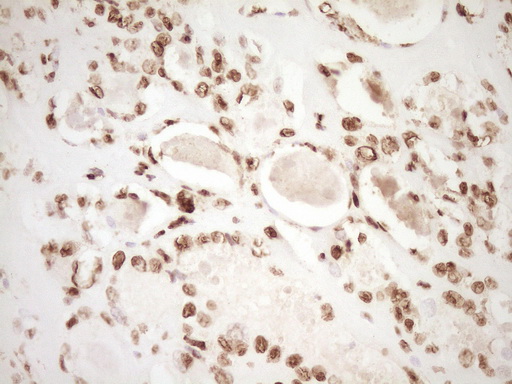 IHC of paraffin-embedded Carcinoma of Human thyroid tissue using anti-SAE1 mouse monoclonal antibody. (Heat-induced epitope retrieval by 1 mM EDTA in 10mM Tris, pH8.5, 120°C for 3min).