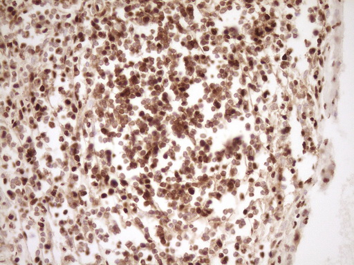 IHC of paraffin-embedded Human thyroid tissue using anti-SAE1 mouse monoclonal antibody. (Heat-induced epitope retrieval by 1 mM EDTA in 10mM Tris, pH8.5, 120°C for 3min).