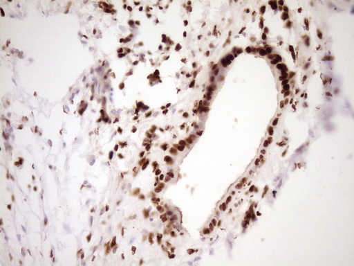IHC of paraffin-embedded Carcinoma of Human pancreas tissue using anti-SAE1 mouse monoclonal antibody. (Heat-induced epitope retrieval by 1 mM EDTA in 10mM Tris, pH8.5, 120°C for 3min).