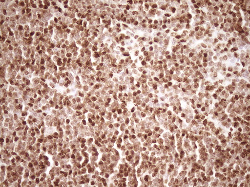 IHC of paraffin-embedded Human lymphoma tissue using anti-SAE1 mouse monoclonal antibody. (Heat-induced epitope retrieval by 1 mM EDTA in 10mM Tris, pH8.5, 120°C for 3min).