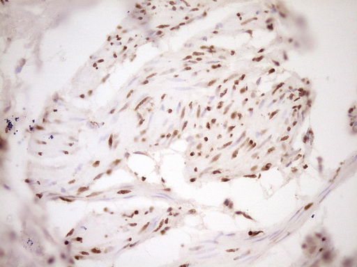 IHC of paraffin-embedded Carcinoma of Human bladder tissue using anti-SAE1 mouse monoclonal antibody. (Heat-induced epitope retrieval by 1 mM EDTA in 10mM Tris, pH8.5, 120°C for 3min).