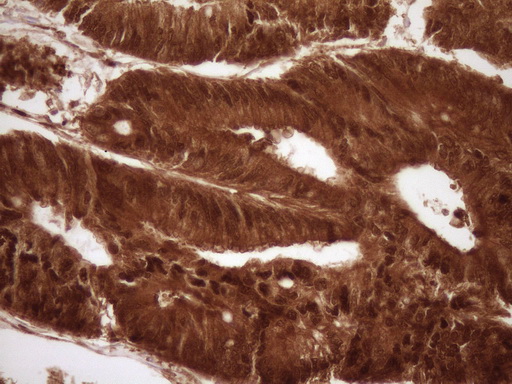 IHC of paraffin-embedded Adenocarcinoma of Human colon tissue using anti-SAE1 mouse monoclonal antibody. (Heat-induced epitope retrieval by 1 mM EDTA in 10mM Tris, pH8.5, 120°C for 3min).