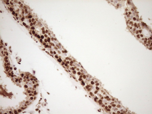IHC of paraffin-embedded Adenocarcinoma of Human breast tissue using anti-SAE1 mouse monoclonal antibody. (Heat-induced epitope retrieval by 1 mM EDTA in 10mM Tris, pH8.5, 120°C for 3min).