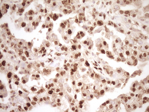 IHC of paraffin-embedded Adenocarcinoma of Human ovary tissue using anti-SAE1 mouse monoclonal antibody. (Heat-induced epitope retrieval by 1 mM EDTA in 10mM Tris, pH8.5, 120°C for 3min).