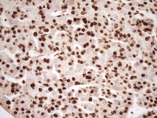 IHC of paraffin-embedded Carcinoma of Human liver tissue using anti-SAE1 mouse monoclonal antibody. (Heat-induced epitope retrieval by 1 mM EDTA in 10mM Tris, pH8.5, 120°C for 3min).