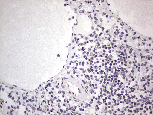 IHC of paraffin-embedded Carcinoma of Human thyroid tissue using anti-SAE1 mouse monoclonal antibody. (Heat-induced epitope retrieval by 1 mM EDTA in 10mM Tris, pH8.5, 120°C for 3min).