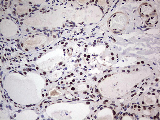 IHC of paraffin-embedded Human thyroid tissue using anti-SAE1 mouse monoclonal antibody. (Heat-induced epitope retrieval by 1 mM EDTA in 10mM Tris, pH8.5, 120°C for 3min).
