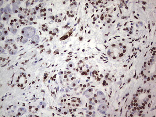IHC of paraffin-embedded Carcinoma of Human pancreas tissue using anti-SAE1 mouse monoclonal antibody. (Heat-induced epitope retrieval by 1 mM EDTA in 10mM Tris, pH8.5, 120°C for 3min).