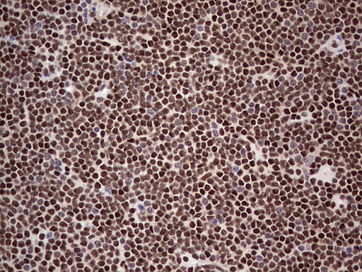 IHC of paraffin-embedded Human lymphoma tissue using anti-SAE1 mouse monoclonal antibody. (Heat-induced epitope retrieval by 1 mM EDTA in 10mM Tris, pH8.5, 120°C for 3min).