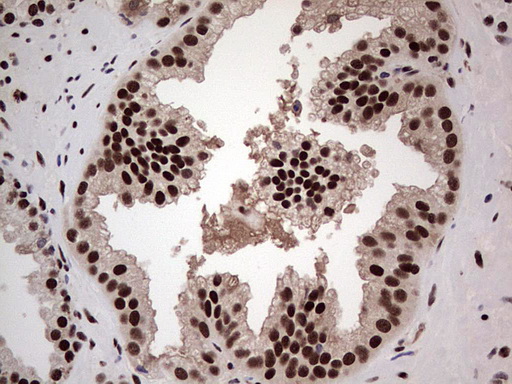 IHC of paraffin-embedded Carcinoma of Human prostate tissue using anti-SAE1 mouse monoclonal antibody. (Heat-induced epitope retrieval by 1 mM EDTA in 10mM Tris, pH8.5, 120°C for 3min).
