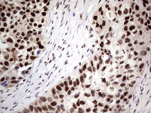 IHC of paraffin-embedded Carcinoma of Human kidney tissue using anti-SAE1 mouse monoclonal antibody. (Heat-induced epitope retrieval by 1 mM EDTA in 10mM Tris, pH8.5, 120°C for 3min).