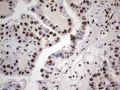 IHC of paraffin-embedded Adenocarcinoma of Human ovary tissue using anti-SAE1 mouse monoclonal antibody. (Heat-induced epitope retrieval by 1 mM EDTA in 10mM Tris, pH8.5, 120°C for 3min).