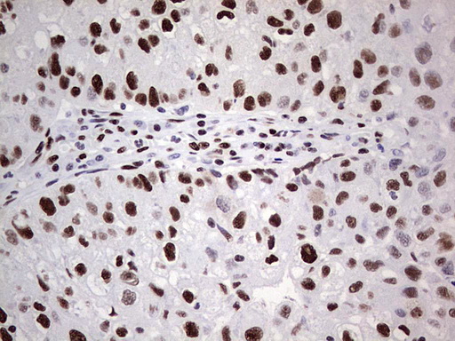IHC of paraffin-embedded Carcinoma of Human lung tissue using anti-SAE1 mouse monoclonal antibody. (Heat-induced epitope retrieval by 1 mM EDTA in 10mM Tris, pH8.5, 120°C for 3min).