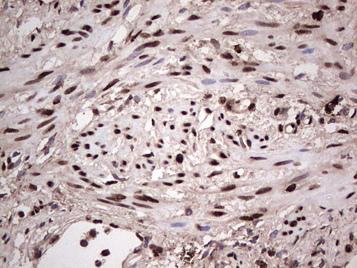 IHC of paraffin-embedded Human endometrium tissue using anti-SAE1 mouse monoclonal antibody. (Heat-induced epitope retrieval by 1 mM EDTA in 10mM Tris, pH8.5, 120°C for 3min).