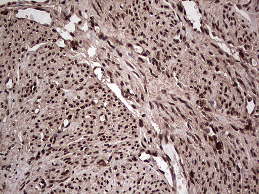 IHC of paraffin-embedded Adenocarcinoma of Human endometrium tissue using anti-SAE1 mouse monoclonal antibody. (Heat-induced epitope retrieval by 1 mM EDTA in 10mM Tris, pH8.5, 120°C for 3min).