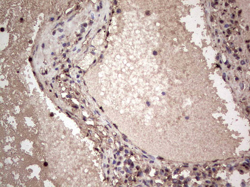 IHC of paraffin-embedded Carcinoma of Human thyroid tissue using anti-SAE1 mouse monoclonal antibody. (Heat-induced epitope retrieval by 1 mM EDTA in 10mM Tris, pH8.5, 120°C for 3min).