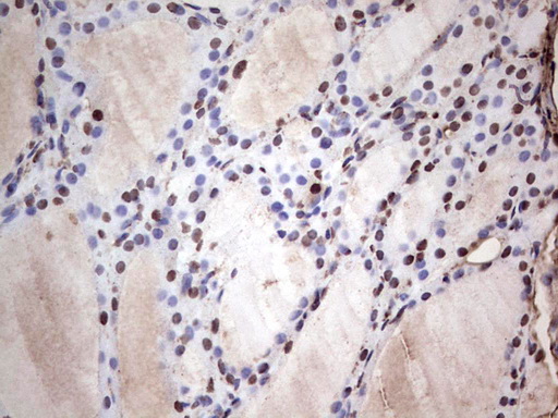 IHC of paraffin-embedded Human thyroid tissue using anti-SAE1 mouse monoclonal antibody. (Heat-induced epitope retrieval by 1 mM EDTA in 10mM Tris, pH8.5, 120°C for 3min).