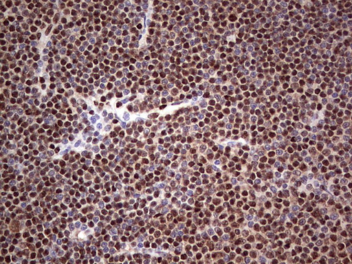 IHC of paraffin-embedded Human lymphoma tissue using anti-SAE1 mouse monoclonal antibody. (Heat-induced epitope retrieval by 1 mM EDTA in 10mM Tris, pH8.5, 120°C for 3min).
