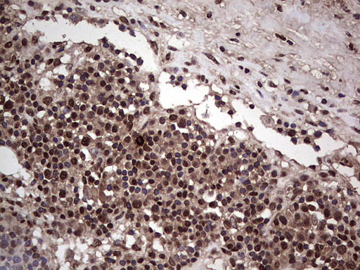 IHC of paraffin-embedded Carcinoma of Human bladder tissue using anti-SAE1 mouse monoclonal antibody. (Heat-induced epitope retrieval by 1 mM EDTA in 10mM Tris, pH8.5, 120°C for 3min).