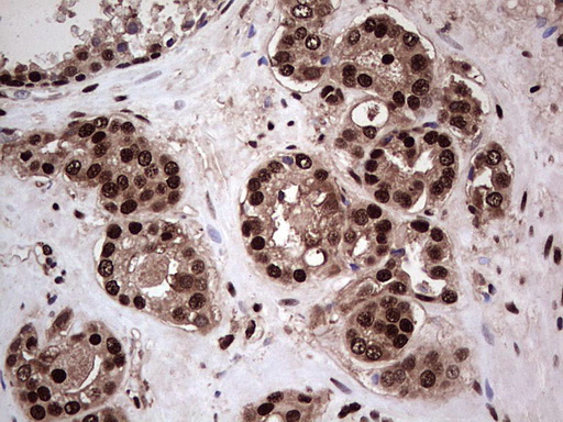 IHC of paraffin-embedded Carcinoma of Human prostate tissue using anti-SAE1 mouse monoclonal antibody. (Heat-induced epitope retrieval by 1 mM EDTA in 10mM Tris, pH8.5, 120°C for 3min).