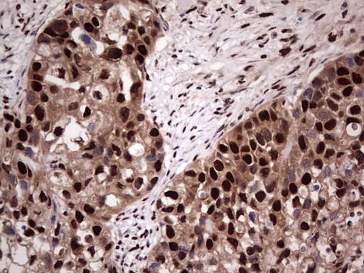 IHC of paraffin-embedded Carcinoma of Human kidney tissue using anti-SAE1 mouse monoclonal antibody. (Heat-induced epitope retrieval by 1 mM EDTA in 10mM Tris, pH8.5, 120°C for 3min).