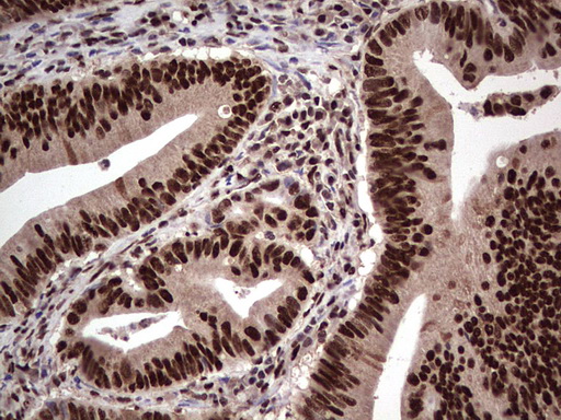 IHC of paraffin-embedded Adenocarcinoma of Human colon tissue using anti-SAE1 mouse monoclonal antibody. (Heat-induced epitope retrieval by 1 mM EDTA in 10mM Tris, pH8.5, 120°C for 3min).