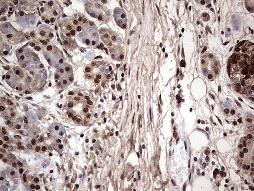 IHC of paraffin-embedded Carcinoma of Human pancreas tissue using anti-SAE1 mouse monoclonal antibody. (Heat-induced epitope retrieval by 1 mM EDTA in 10mM Tris, pH8.5, 120°C for 3min).
