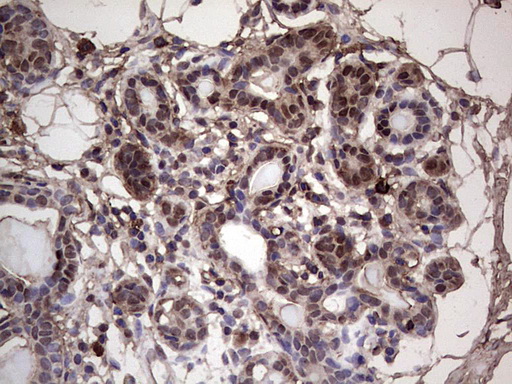 IHC of paraffin-embedded Human breast tissue using anti-SAE1 mouse monoclonal antibody. (Heat-induced epitope retrieval by 1 mM EDTA in 10mM Tris, pH8.5, 120°C for 3min).