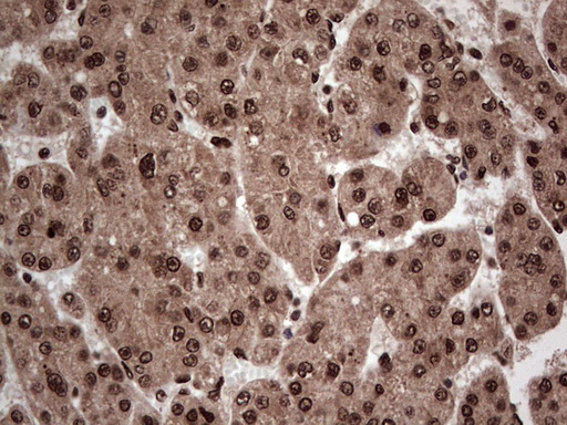 IHC of paraffin-embedded Carcinoma of Human liver tissue using anti-SAE1 mouse monoclonal antibody. (Heat-induced epitope retrieval by 1 mM EDTA in 10mM Tris, pH8.5, 120°C for 3min).