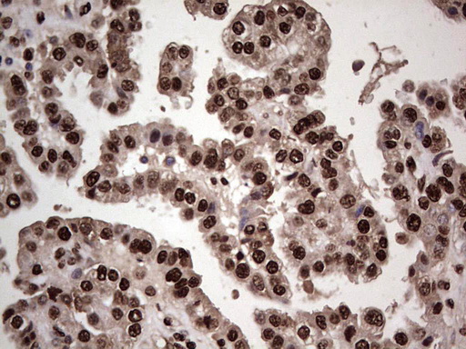 IHC of paraffin-embedded Adenocarcinoma of Human ovary tissue using anti-SAE1 mouse monoclonal antibody. (Heat-induced epitope retrieval by 1 mM EDTA in 10mM Tris, pH8.5, 120°C for 3min).