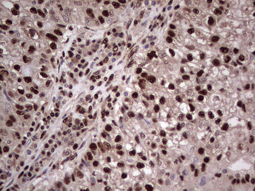 IHC of paraffin-embedded Carcinoma of Human lung tissue using anti-SAE1 mouse monoclonal antibody. (Heat-induced epitope retrieval by 1 mM EDTA in 10mM Tris, pH8.5, 120°C for 3min).