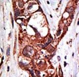 Formalin-fixed and paraffin-embedded human cancer tissue reacted with the primary antibody, which was peroxidase-conjugated to the secondary antibody, followed by DAB staining. This data demonstrates the use of this antibody for immunohistochemistry; clinical relevance has not been evaluated. BC = breast carcinoma; HC = hepatocarcinoma.