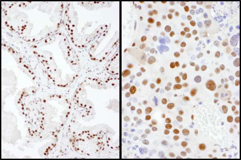 Detection of Human and Mouse SAE2 by Immunohistochemistry. Sample: FFPE sections of human prostate carcinoma (left) and mouse renal cell carcinoma (right). Antibody: Affinity purified rabbit anti-SAE2 used at a dilution of 1:200 (1 ug/ml). Detection: DAB.