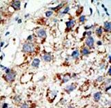 Formalin-fixed and paraffin-embedded human cancer tissue reacted with the primary antibody, which was peroxidase-conjugated to the secondary antibody, followed by AEC staining. This data demonstrates the use of this antibody for immunohistochemistry; clinical relevance has not been evaluated. BC = breast carcinoma; HC = hepatocarcinoma.