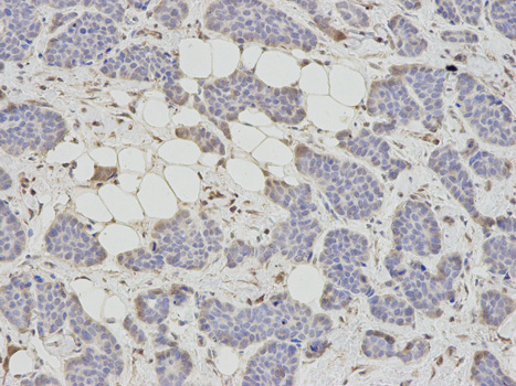 Immunohistochemistry of paraffin-embedded human breast cancer using AHCY antibody at dilution of 1:200 (200x lens).