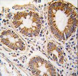 Formalin-fixed and paraffin-embedded human hepatocarcinoma tissue reacted with AHCY antibody , which was peroxidase-conjugated to the secondary antibody, followed by DAB staining. This data demonstrates the use of this antibody for immunohistochemistry; clinical relevance has not been evaluated.