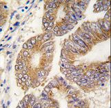 Formalin-fixed and paraffin-embedded human colon carcinoma tissue reacted with AHCY antibody , which was peroxidase-conjugated to the secondary antibody, followed by DAB staining. This data demonstrates the use of this antibody for immunohistochemistry; clinical relevance has not been evaluated.