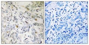 IHC of paraffin-embedded human breast carcinoma tissue, using HCC1 Antibody. The sample on the right was incubated with synthetic peptide.