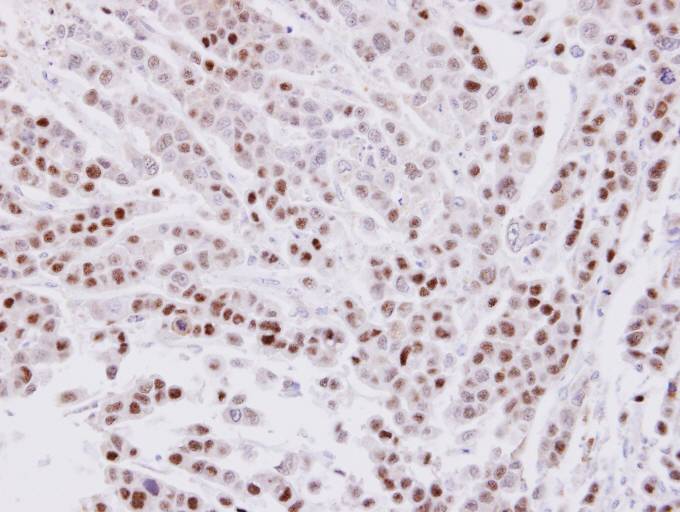 IHC of paraffin-embedded MDAMB-468 xenograft using CIP29 antibody at 1:100 dilution.