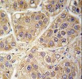Formalin-fixed and paraffin-embedded human hepatocarcinoma tissue reacted with SARS2 antibody , which was peroxidase-conjugated to the secondary antibody, followed by DAB staining. This data demonstrates the use of this antibody for immunohistochemistry; clinical relevance has not been evaluated.