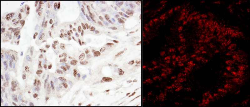 Detection of Human SART3/TIP110 by Immunohistochemistry and Immunofluorescence. Sample: FFPE sections of human ovarian carcinoma (left) and colon carcinoma (right). Antibody: Affinity purified rabbit anti-SART3/TIP110 used at a dilution of 1:200 (1 ug/ml) and 1:400 (0.5 ug/ml). Detection: DAB and Red-fluorescent Goat anti-Rabbit IgG-heavy and light chain, cross-adsorbed Antibody DyLight 594 Conjugated used at a dilution of 1:100.