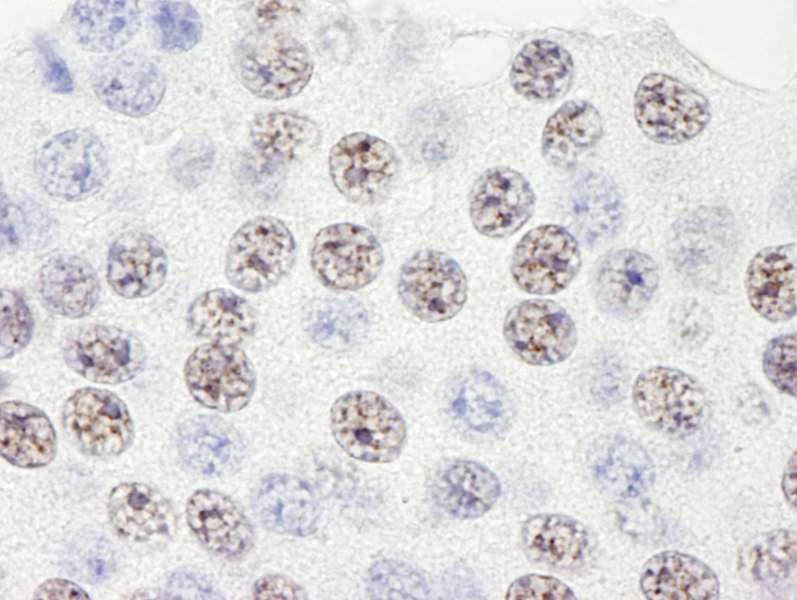 Detection of Human SART3/TIP110 by Immunohistochemistry. Sample: FFPE section of human pancreatic islet cell tumor. Antibody: Affinity purified rabbit anti-SART3/TIP110 used at a dilution of 1:250.