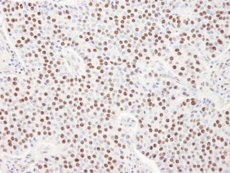 Detection of Human SART3/TIP110 by Immunohistochemistry. Sample: FFPE section of human pancreatic islet cell tumor. Antibody: Affinity purified rabbit anti-SART3/TIP110 used at a dilution of 1:100.