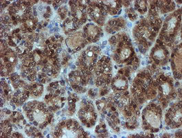 IHC of paraffin-embedded Carcinoma of Human thyroid tissue using anti-SAT2 mouse monoclonal antibody. (Heat-induced epitope retrieval by 10mM citric buffer, pH6.0, 100C for 10min).