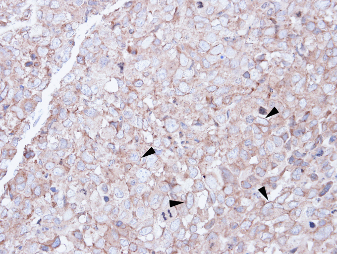 IHC of paraffin-embedded CL1-0 xenograft using SCARA3 antibody at 1:100 dilution.