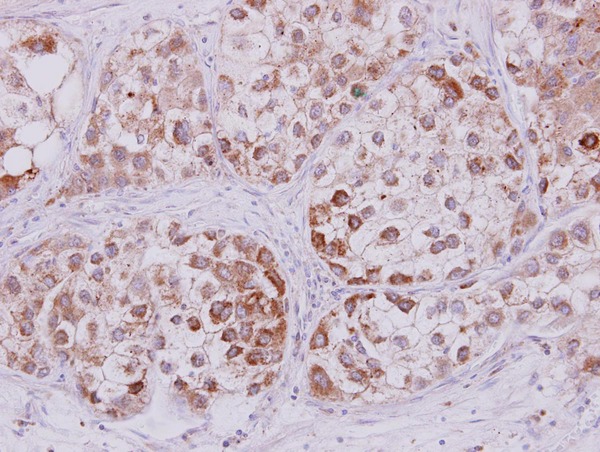 STMN2 antibody detects STMN2 protein at cytoplasm on Liver carcinoma by immunohistochemical analysis. Sample: Paraffin-embedded Liver carcinoma. STMN2 antibody dilution:1:250.
