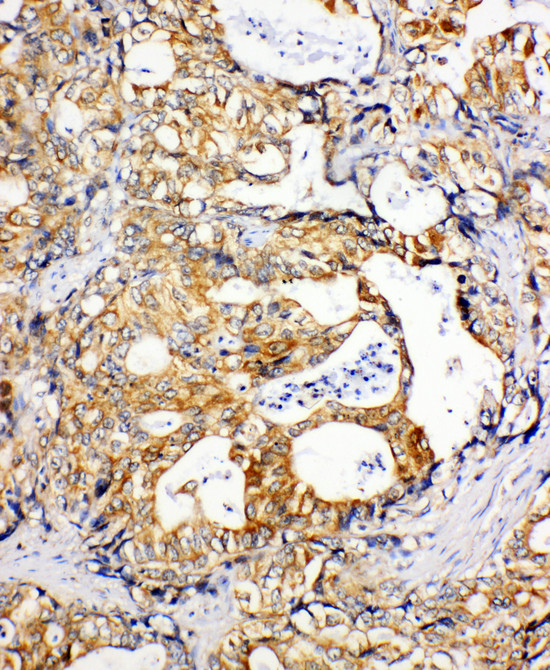 SDHC antibody. IHC(P): Human Gastric Cancer Tissue.
