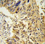 SDR Antibody IHC of formalin-fixed and paraffin-embedded lung carcinoma followed by peroxidase-conjugated secondary antibody and DAB staining.